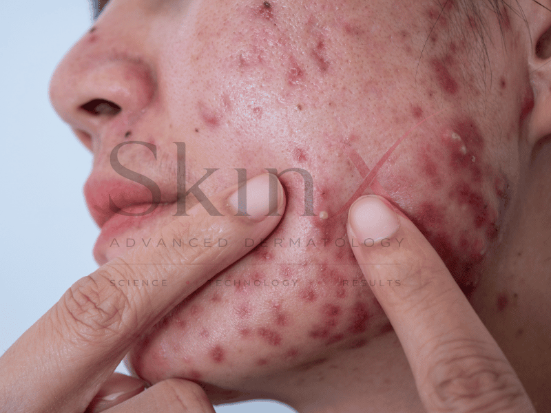Mụn viêm nhiều, khiến da tổn thương sâu 